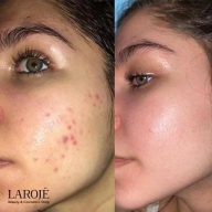 ژل ضد جوش دیفرین Differin - تصویر ۴