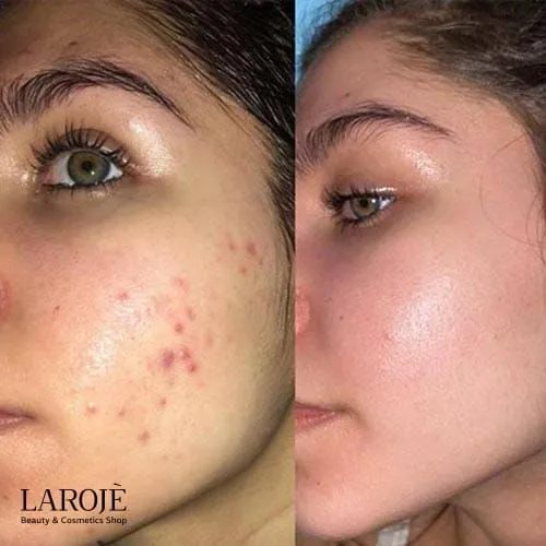 ژل ضد جوش دیفرین Differin - تصویر ۴