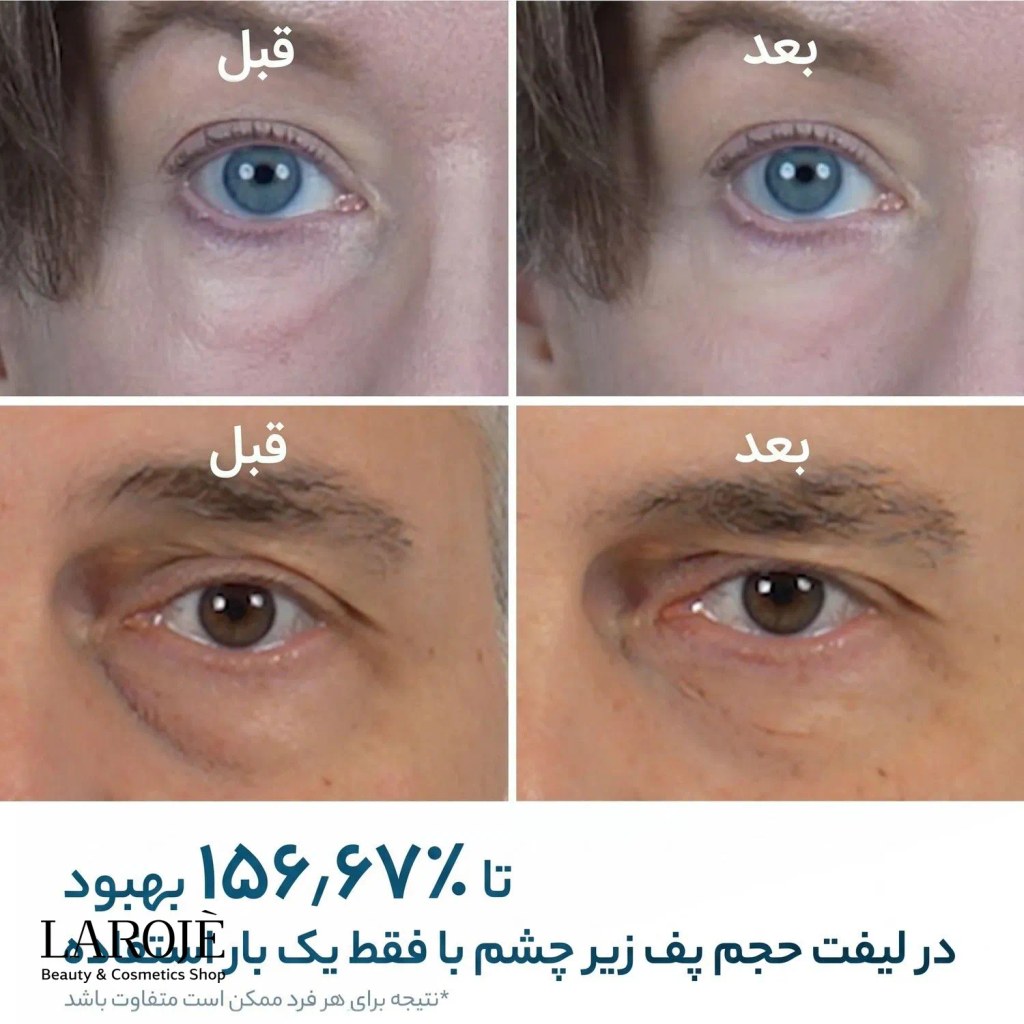 قبل و بعد از یک بار استفاده از کرم دور چشم Eyephalt در کاهش پف زیر چشم