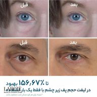 قبل و بعد از یک بار استفاده از کرم دور چشم Eyephalt در کاهش پف زیر چشم