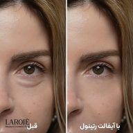 قبل و بعد از استفاده از کرم دور چشم رتینول Eyephalt دکتر ملاکسین