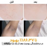 قبل و بعد از یک بار استفاده از اسپری Peel Shot دکتر ملاکسین روی پوست بدن